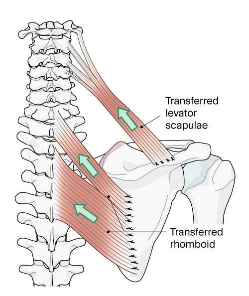 medical illustration of shoulder showing levator scapulae and rhomboid muscle transfer